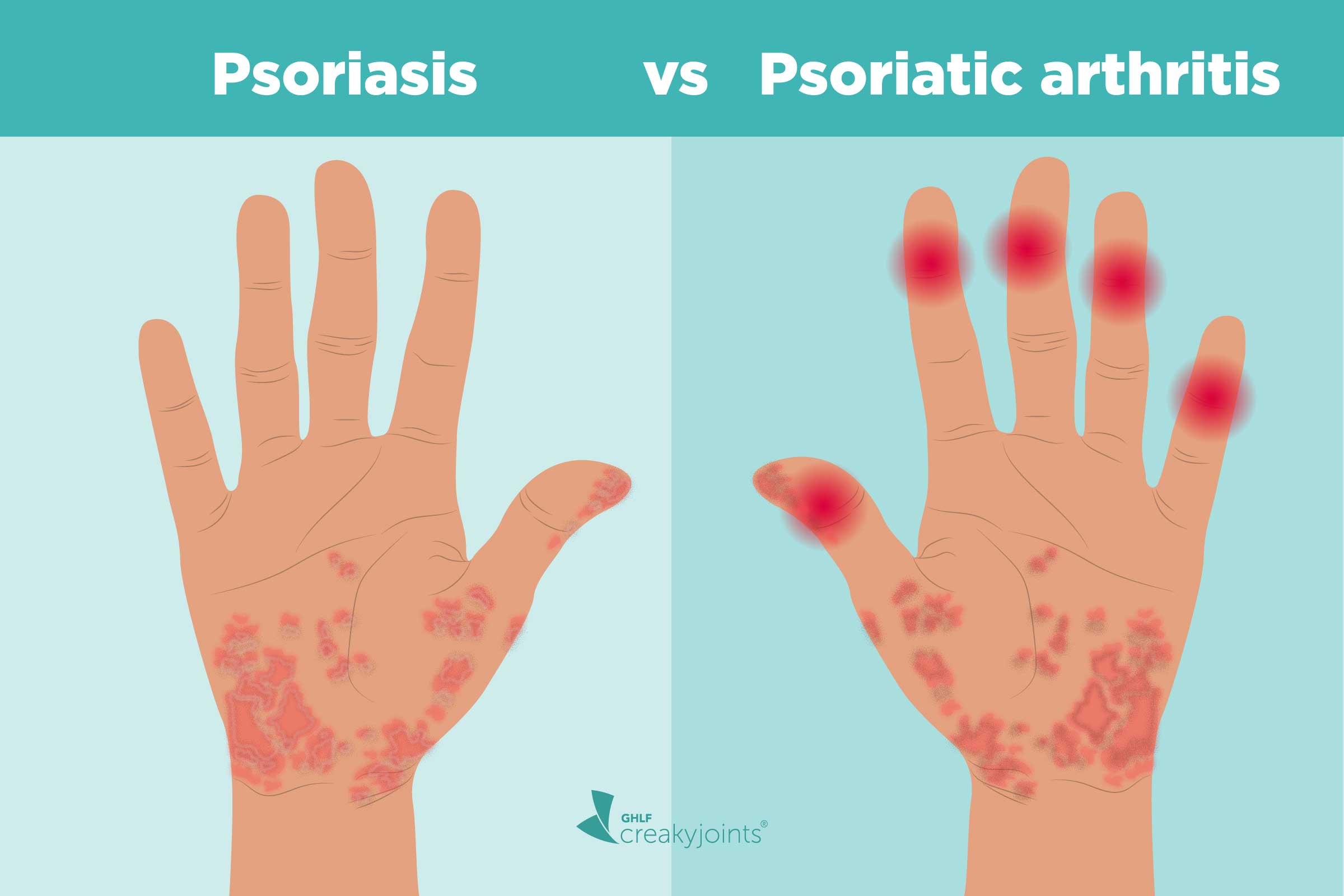 Can Psoriatic Arthritis Go Into Remission?