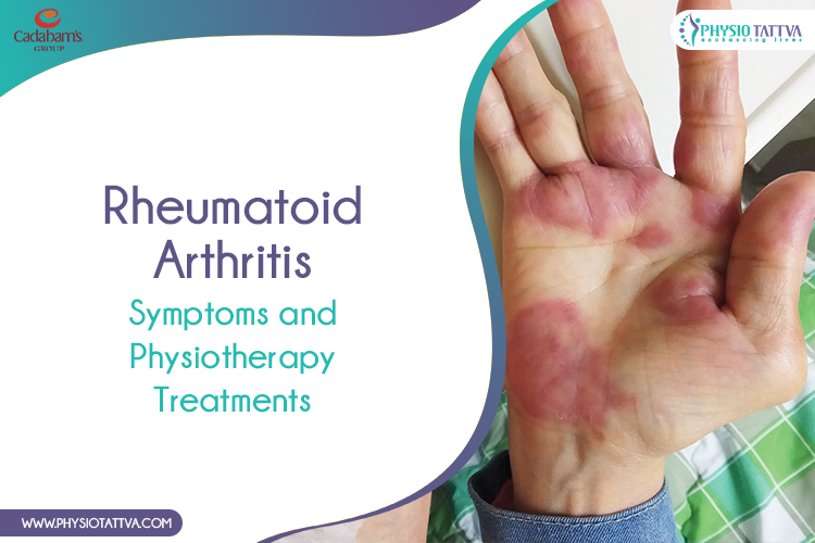 Living with Rheumatoid Arthritis: Treatment Goals, Medications, and Lifestyle Changes