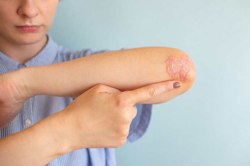 What is Psoriasis? A Comprehensive Guide
