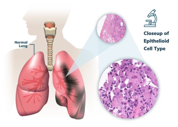 What Is Mesothelioma: A Comprehensive Guide
