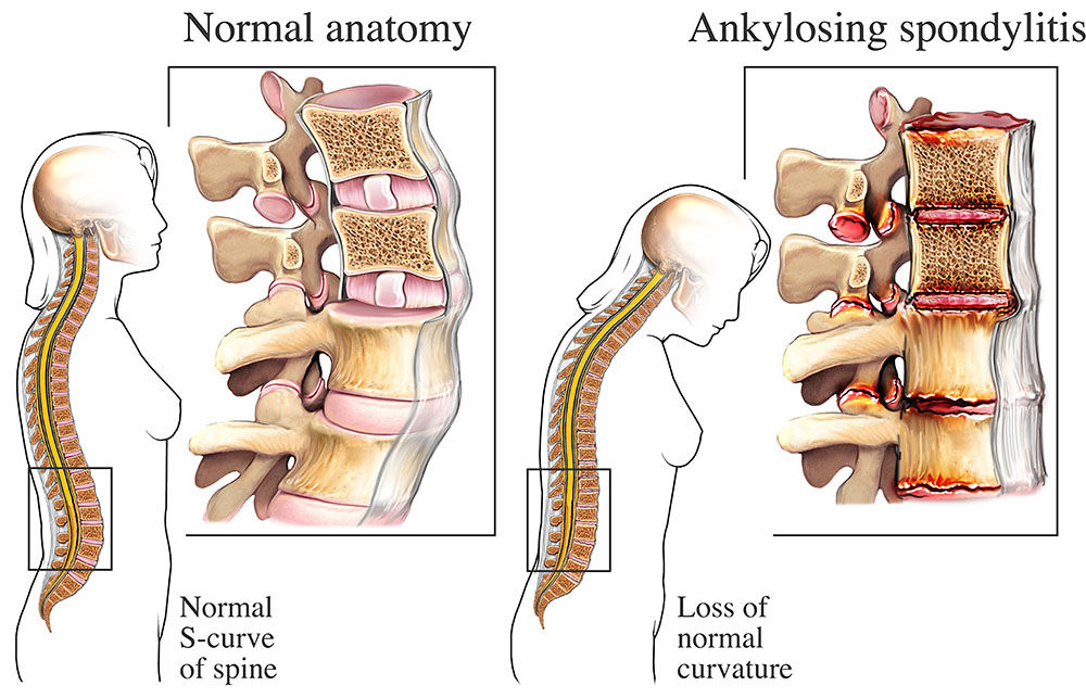 Ankylosing Spondylitis: Understanding the Basics and Treatment Options